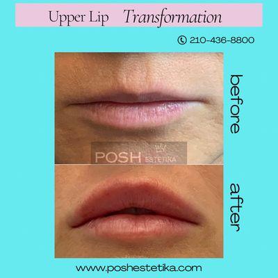 Lip transformation with dermal filler