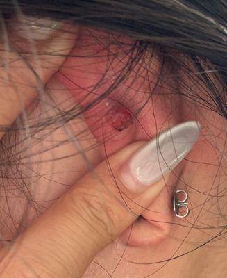 Infected helix piercing keloid puss bump