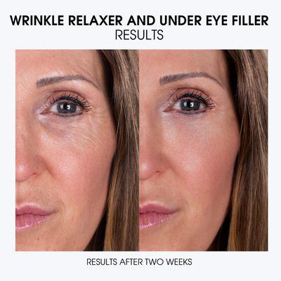 Botox to the crows feet and dark-circle correction with dermal fillers