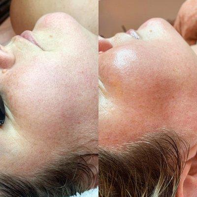 Before/After of Dermaplaning and Hydro Facial + LED Red Light Therapy