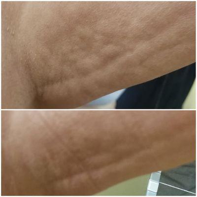 Smoothing and reduction in upper arm after just one supreme wrap!