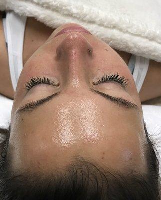 Immediately after a HydraFacial