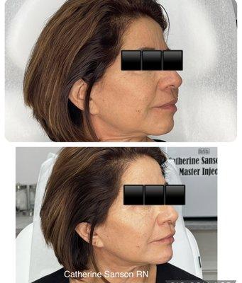 Jawline, presulcus and chin filler