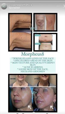 Morpheus8 RF           face & neck and body Treatment