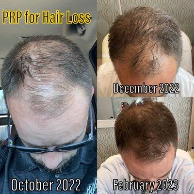 Now offering an amazing Hair Loss Program. Look at these results!!!