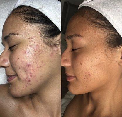 Probiotic Anti Acne Facial Results