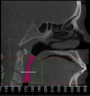 Constricted Airway: Total Airway 4,000