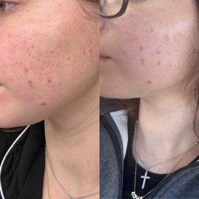 Before & After of customized skincare routine