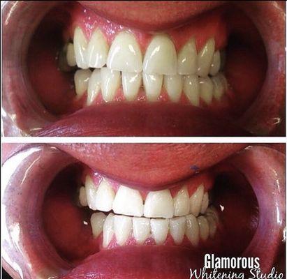 Before and after 1 hour Teeth Whitening