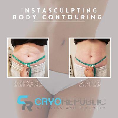 Instasculpting Body Contouring, 1 session results, 2inches down