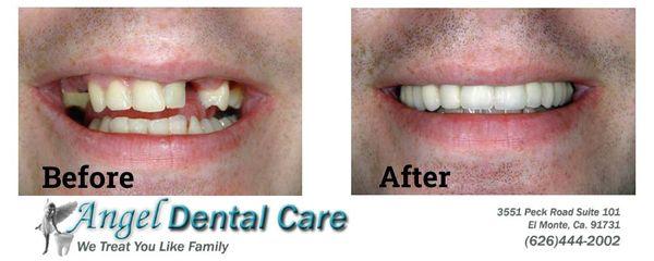 Patient C Before and After Dental Work