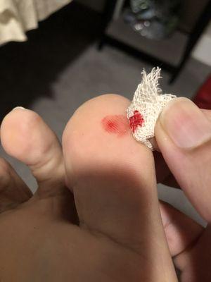 Stubbed toe due to nails under carpet