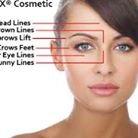 Refresh your Face with Botox!