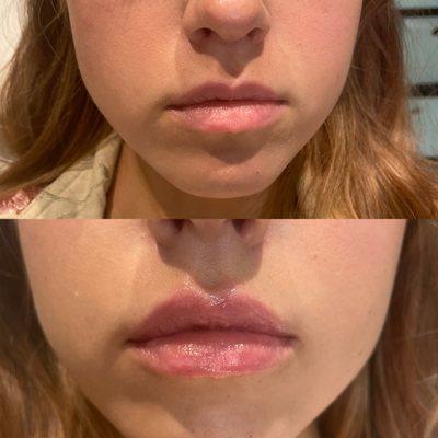 Before and after lip filler with Angie