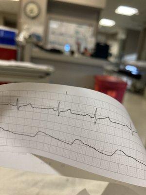 Do you see those glorious P-waves and normal sinus rhythm? BOOM 20% more cardiac output gained.