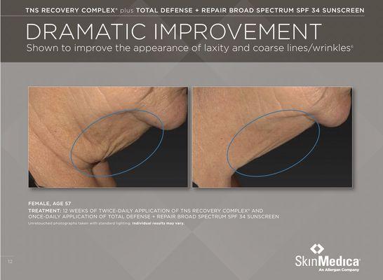 12 weeks after using TNS Recovery Complex by Skin Medica.