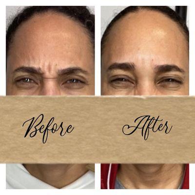 Before and After photos of Botox Injections Alexandria VA