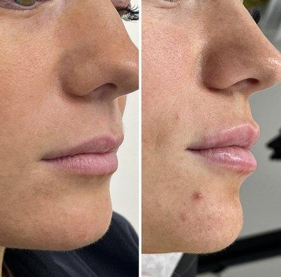 Lip enhancement