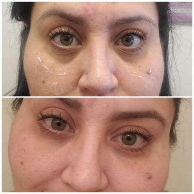 Deep dark circles  are gone. Magic!