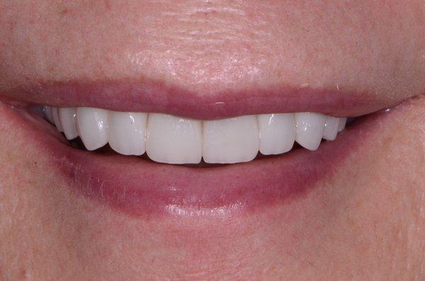 Upper front porcelain veneers, American Academy of Cosmetic Dentistry  done by Dr. Maggie 2021- patient female 55 years old