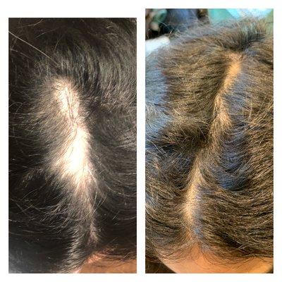 Before and after laser hair treatments on a young client with alopecia areata.