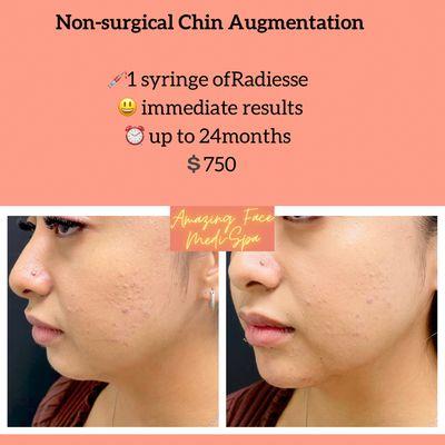 Non surgical chin augmentation