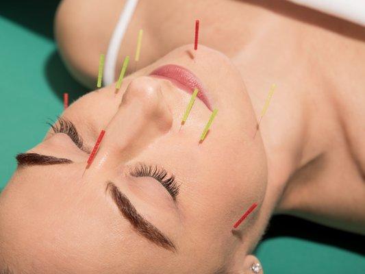 Facial Rejuvenation acupuncture reduces signs of aging naturally