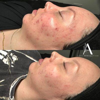 Acne Bootcamp Results