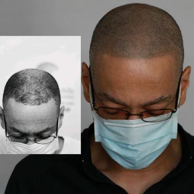 SMP Mobile Scalp Micropigmentation