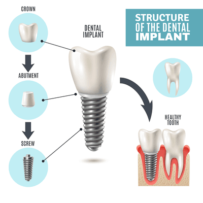 Structure of the dental implant