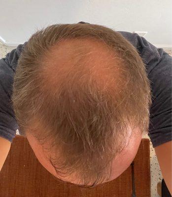 October 2022 - Before hair PRP treatments and the preceding FUE transplant.