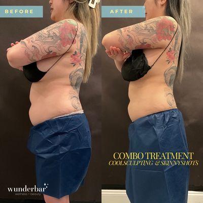 Coolsculpting & Skinnyshots Combo Treatment