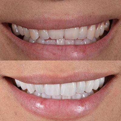 Upper and Lower Porcelain Veneers