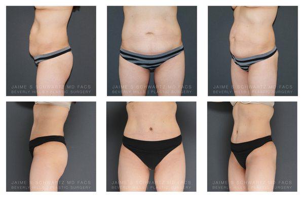 Tummy Tuck