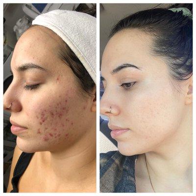 8 months on the acne protocol