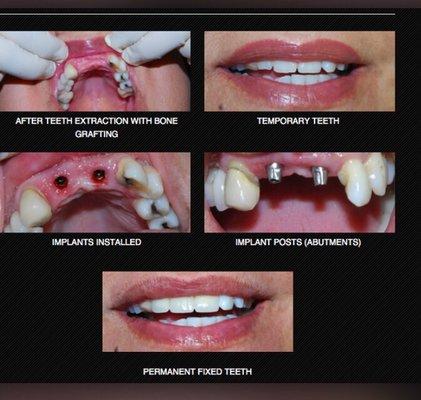 DENTAL IMPLANTS