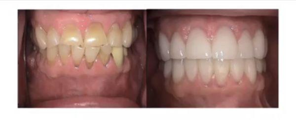 Fractured, worn down and stained teeth- another beautiful full mouth restoration by Dr. Alan Frame.