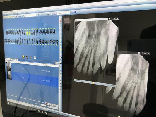 Dental X-Ray