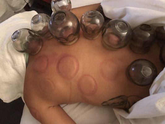 DO you see no skin damage! skin burning or any irritation!  Fire Cupping by Mondi IS SAFE!