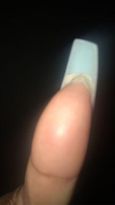 Right thumbnail with nail bed attached