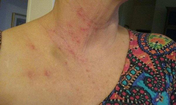 Same case of shingles after one treatment