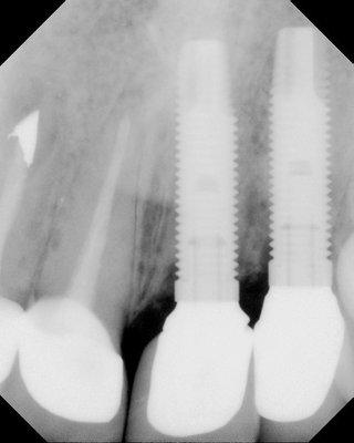 Dental Implants