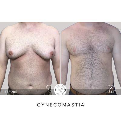 Severe case of Gynecomastia / upper chest lift by plastic surgeon, and gyne specialist, Dr. Joseph Cruise.