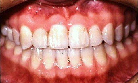 After Multiloop Orthodontics