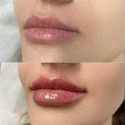 Lip filler! Before and after