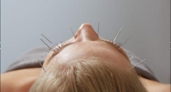 Facial Acupuncture for Rejuvenation and releasing wrikles.