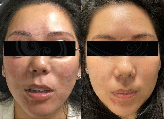 PicoSure FOCUS can even out skin tones in Asian skin safely