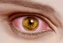 Let us diagnose why your eyes are red!