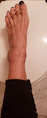 Twisted, swollen ankle