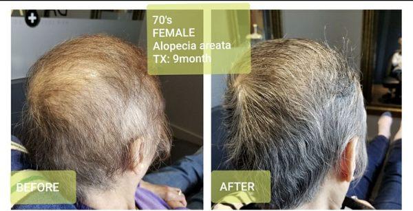 DAMO non-surgical scalp treatment case 
70's Alopecia pattern